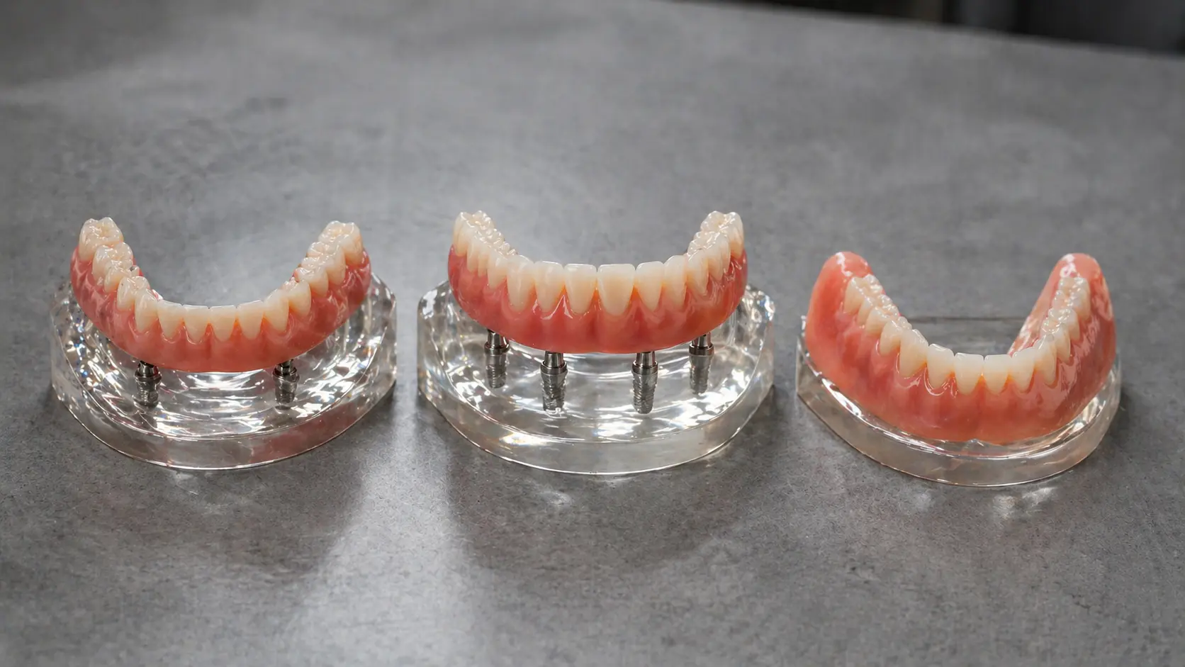 Overdenture vs. Prótese Protocolo vs. Dentadura: Comparativo Completo