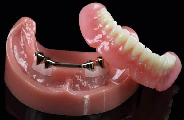 Overdenture