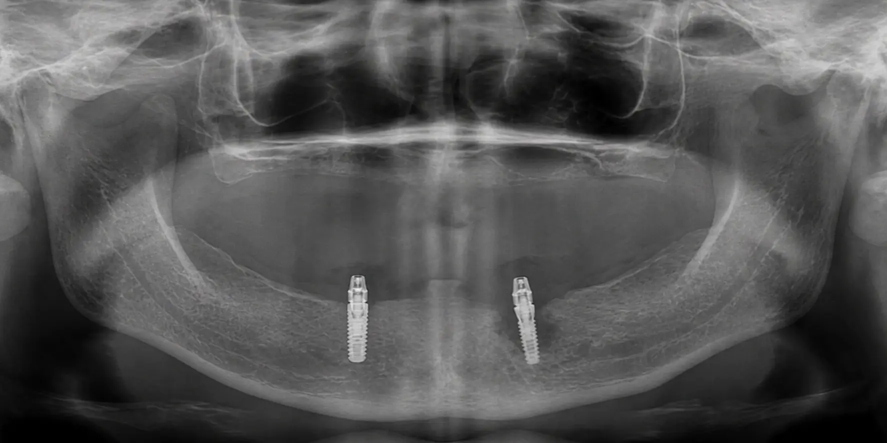 Manutenção e Higiene da Prótese Overdenture