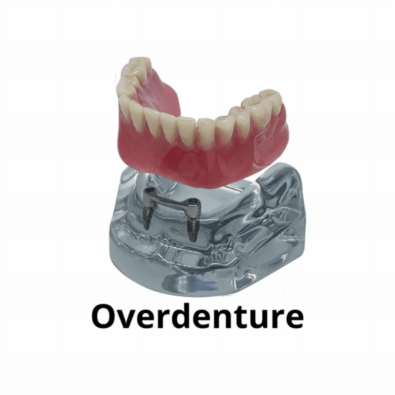 O que é Overdenture e como funciona